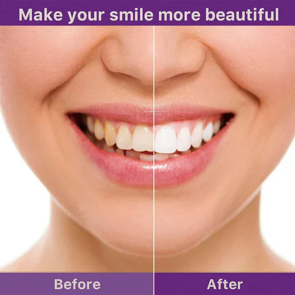 Teeth Whitening